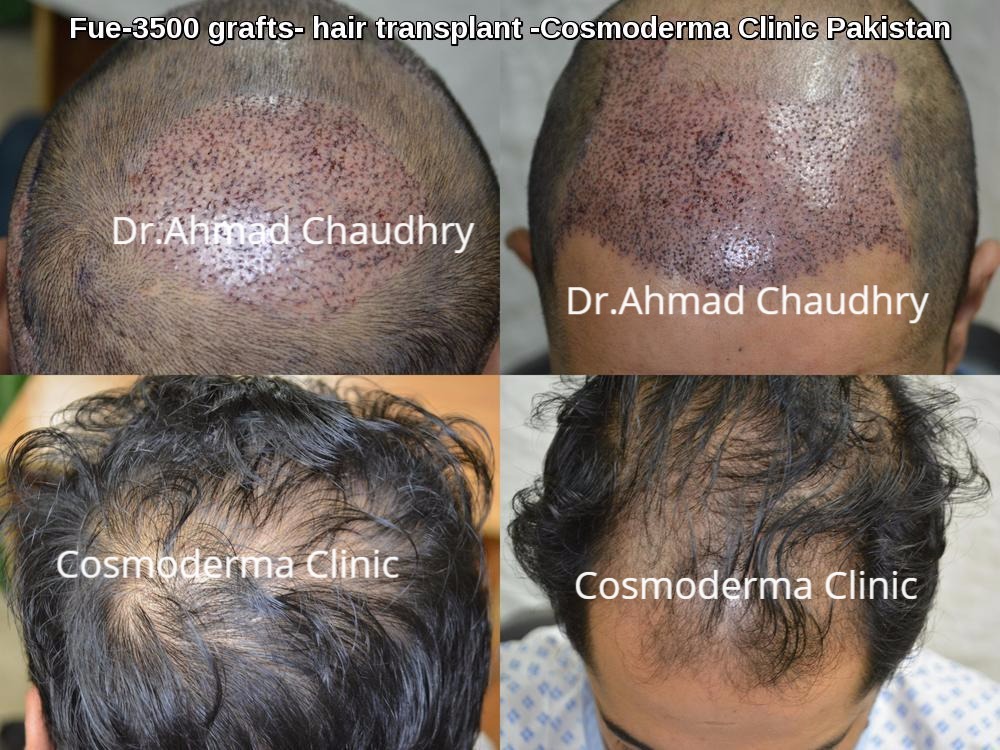 Fue 3500 Grafts hair transplant Pakistan -Cosmoderma Clinic Lahore-   Chaudhry