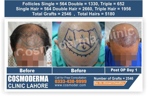 Diabetic Patient Fue Hair Transplant 2546 Grafts Results -Cosmoderma clinic  Pakistan