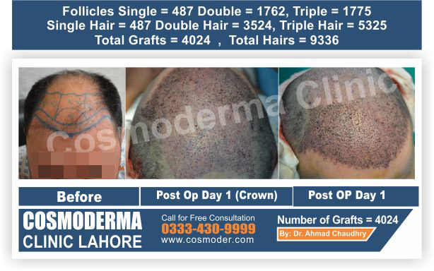 Advance Level Class 6 Hair transplant -Cosmoderma Clinic Pakistan