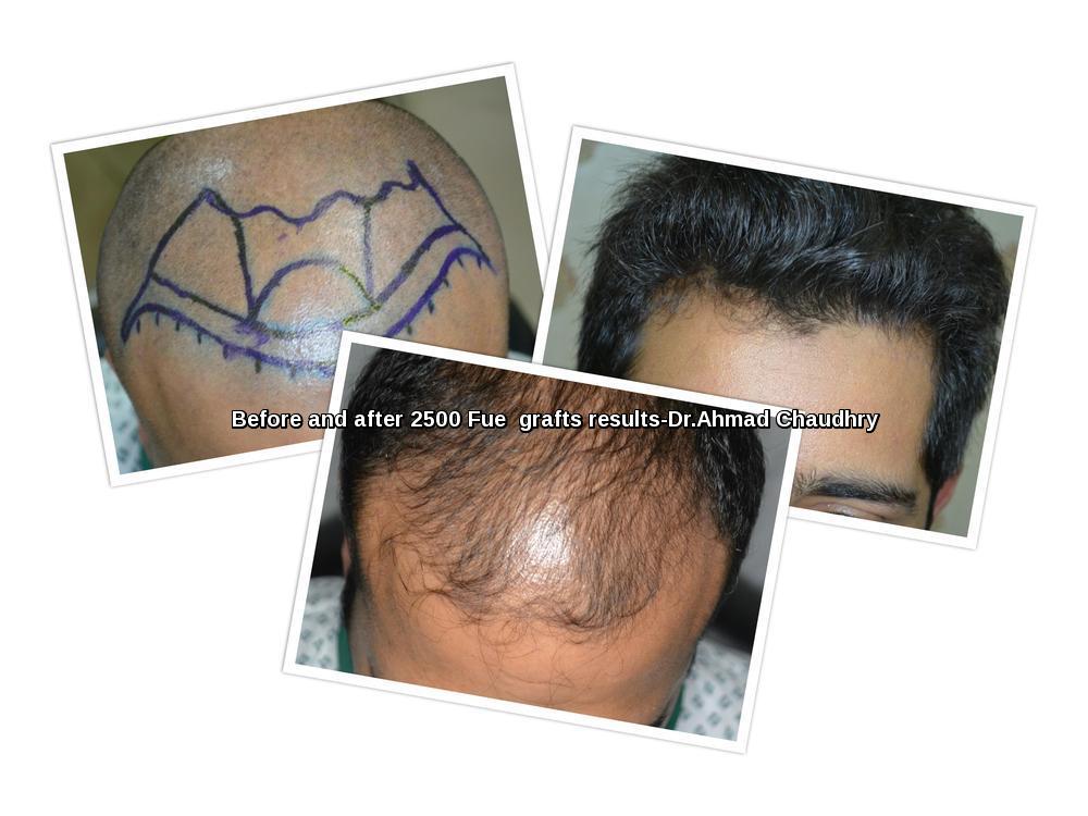Fue hair transplant result -2500 FUE Grafts – Cosmoderma Clinic Pakistan