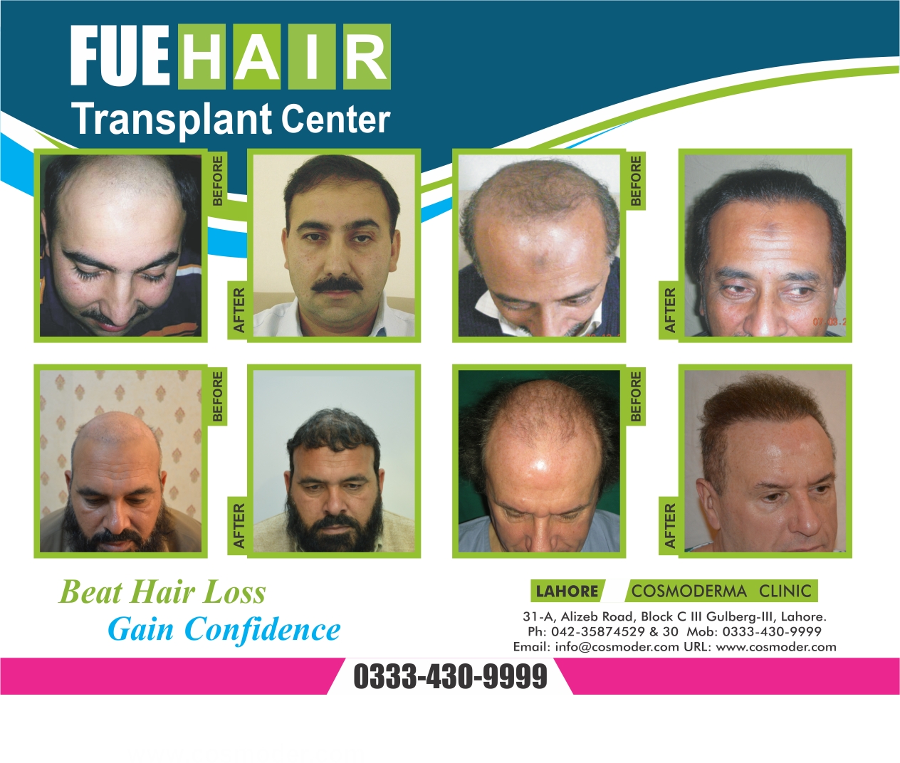 Hair Transplantation clinic in Lahore Pakistan | Best hair loss solution |  Cosmoderma