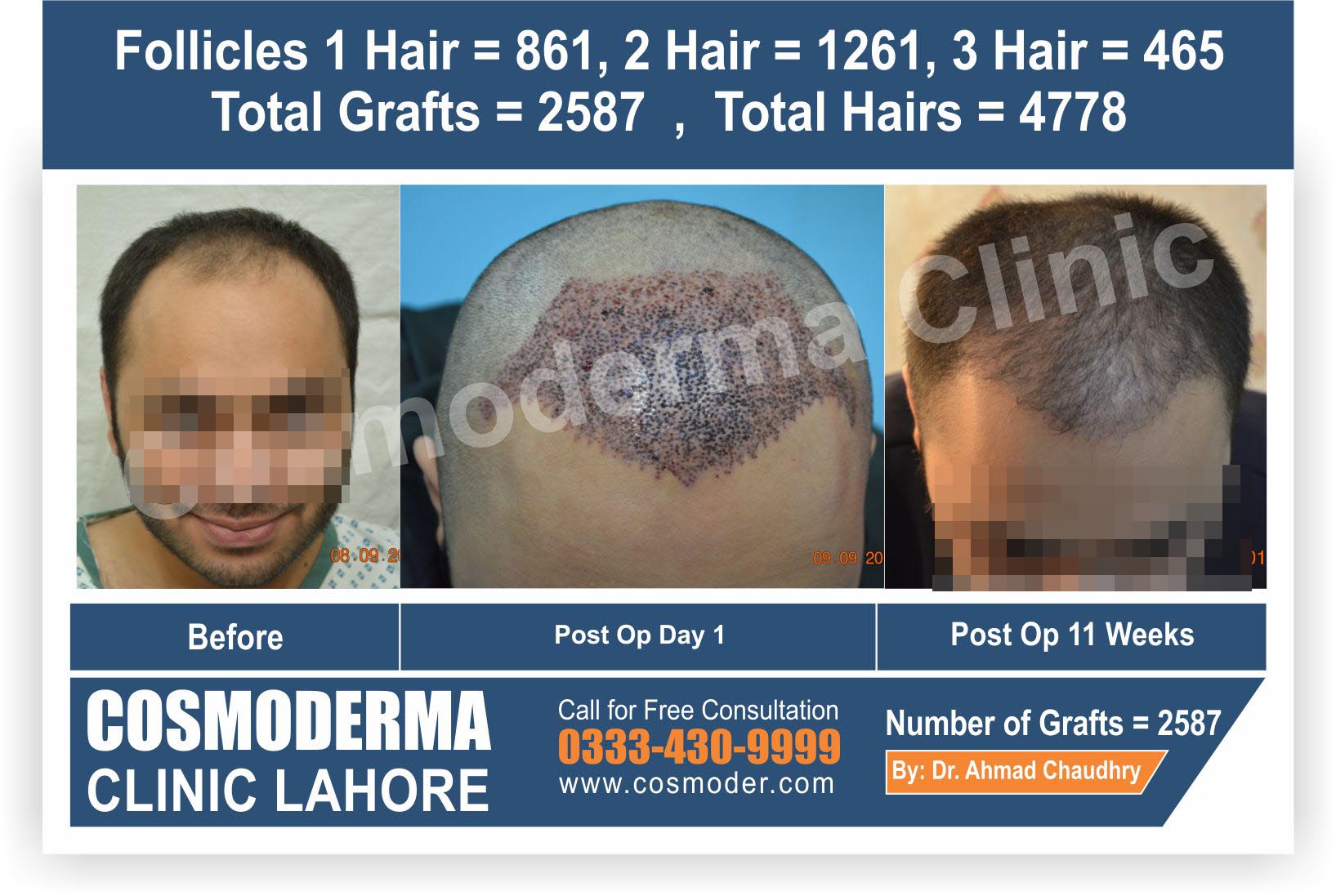 FUE Hair Transplant Results after three Months