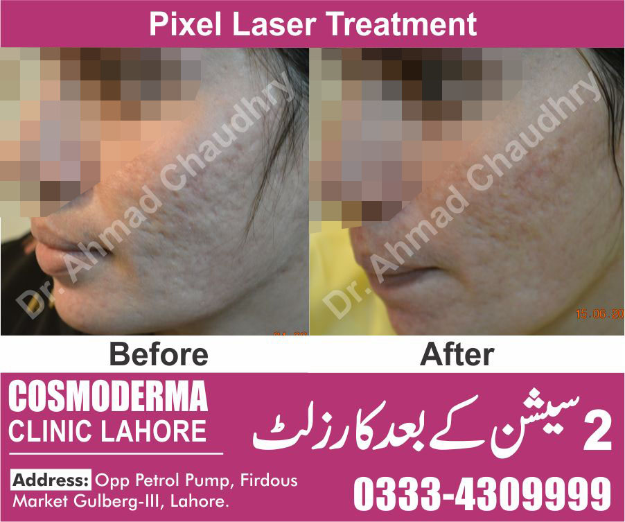 Laser Treatment For Acne And Pigmentation In Pakistan Lahore